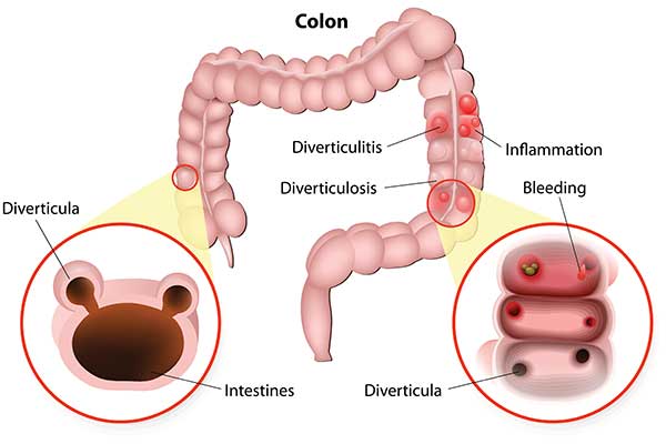 Diverticulosis and Diverticulitis