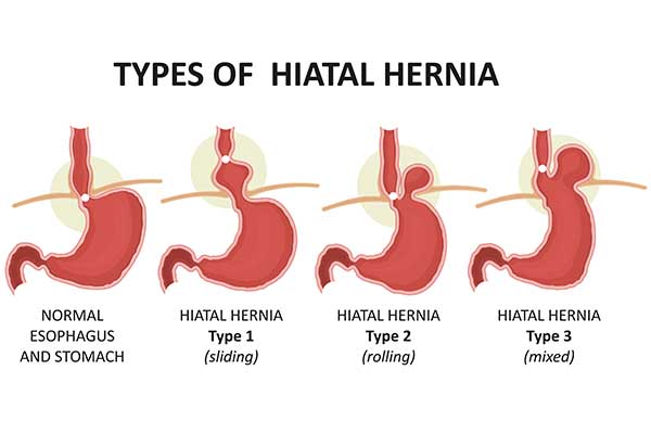 types of hiatal hernia
